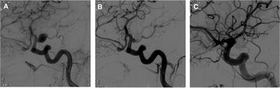 Spontaneous regression of multiple flow-related aneurysms 